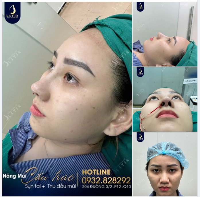 Cùng bạn thân đi nâng mũi là trải nghiệm như thế nào