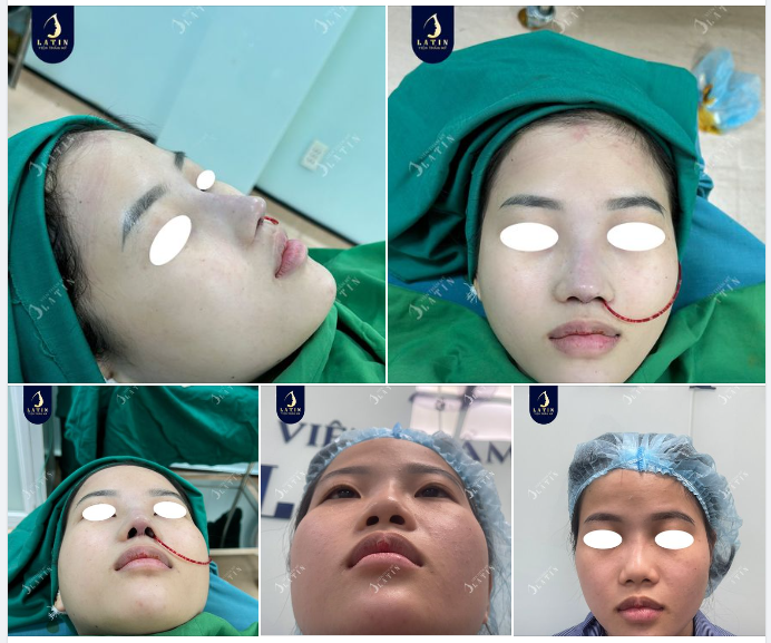 Khủng hoảng vì mũi co rút do đã từng nâng mũi chỉ trước đó, thật may mắn vì em đã được người thân "chỉ điểm" địa chỉ nâng mũi uy tín