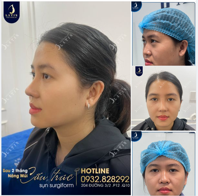 Mũi 2 tháng quá đẹp trong ngày đến tái khám của em gái.
