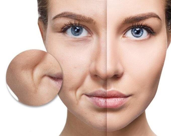 Các phương pháp xóa rãnh cười hiệu quả nhất hiện nay?