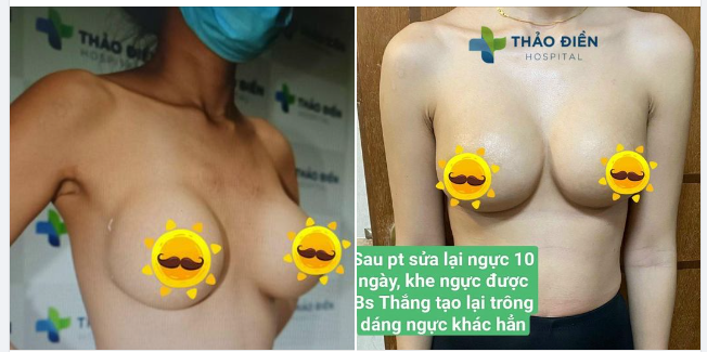 TÁC HẠI CỦA VIỆC CHỌN CƠ SỞ, VIỆN THẨM MỸ PHẪU THUẬT NÂNG NGỰC KHÔNG UY TÍN VÀ AN TOÀN