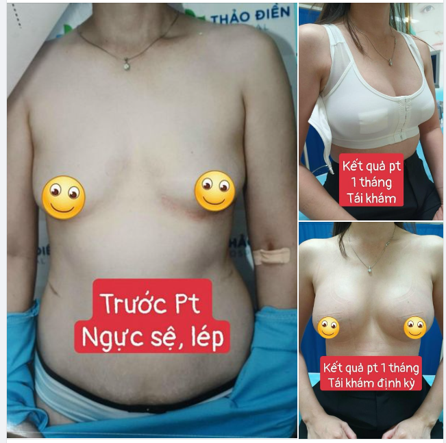 TÁI TẠO VÒNG 1 SAU SINH KHUYẾT ĐIỂM CHỖ NÀO - CHỈNH SỬA CHỖ ĐÓ