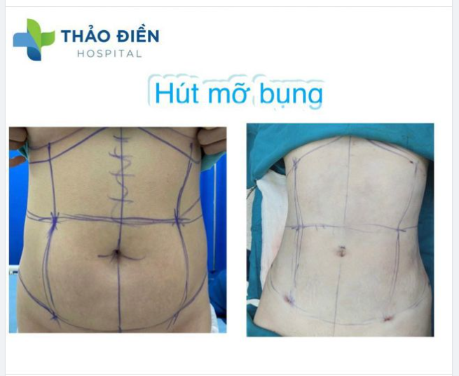 Ưu đãi trong tháng. GIẢM HẾT CỠ!!​​​​​​​ NGỰC SEXY- EO MINI Nhanh tay book lịch sở hữu ngực đẹp, eo thon với giá tốt nhất năm ưu đãi đến 15%.