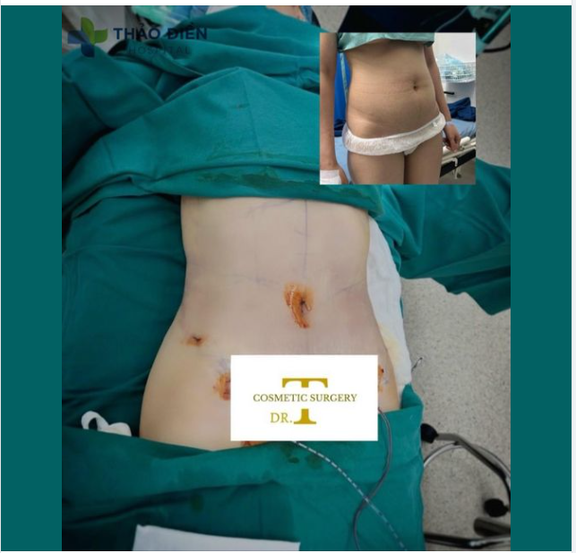 Công nghệ SLIM BODY- TRIỆT ĐỂ 0% MỠ THỪA QUY TRÌNH KIẾN TẠO VÒNG 2 QUYẾN RŨ: