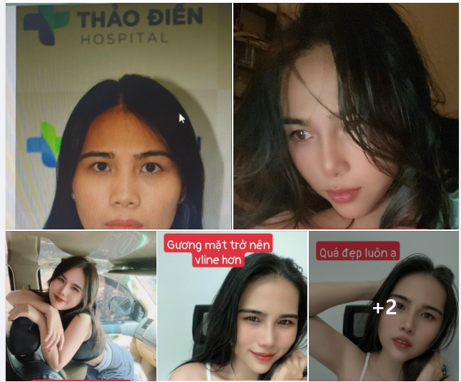 FEEDBACK COMBO NÂNG MŨI CẤU TRÚC+ ĐỘN CẰM VILINE