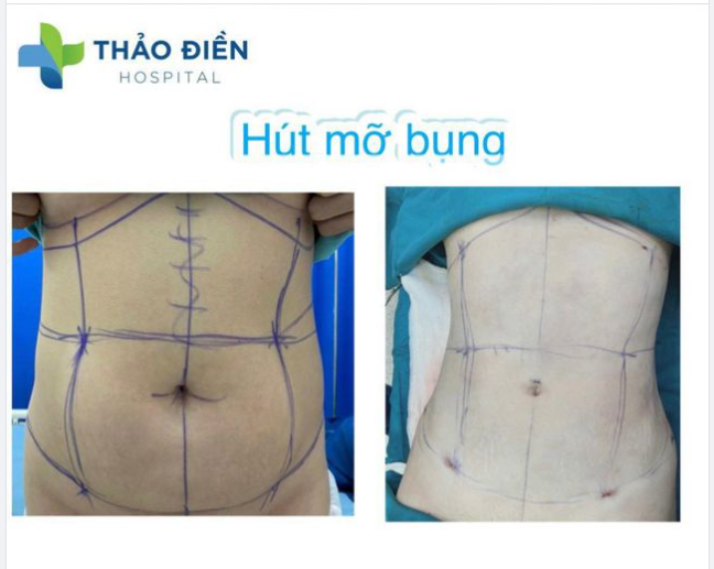 Ưu đãi trong tháng. GIẢM HẾT CỠ!!​​​​​​​ NGỰC SEXY- EO MINI Nhanh tay book lịch sở hữu ngực đẹp, eo thon với giá tốt nhất năm ưu đãi đến 15%.