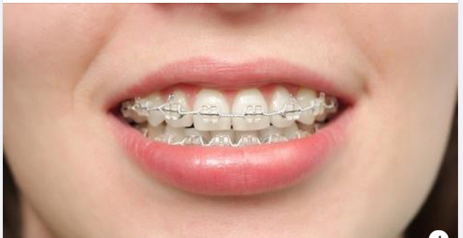 Niềng Răng Bằng Mắc Cài Sứ Có Tốt Không?