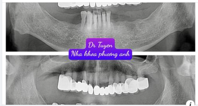 Cấy ghép implant có tốt không?