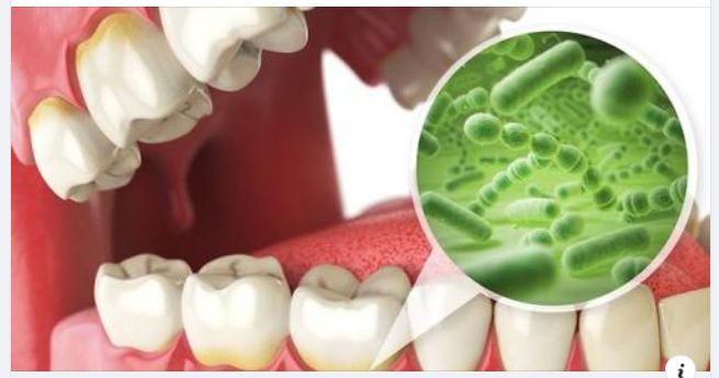 Răng sâu có tẩy trắng được không?