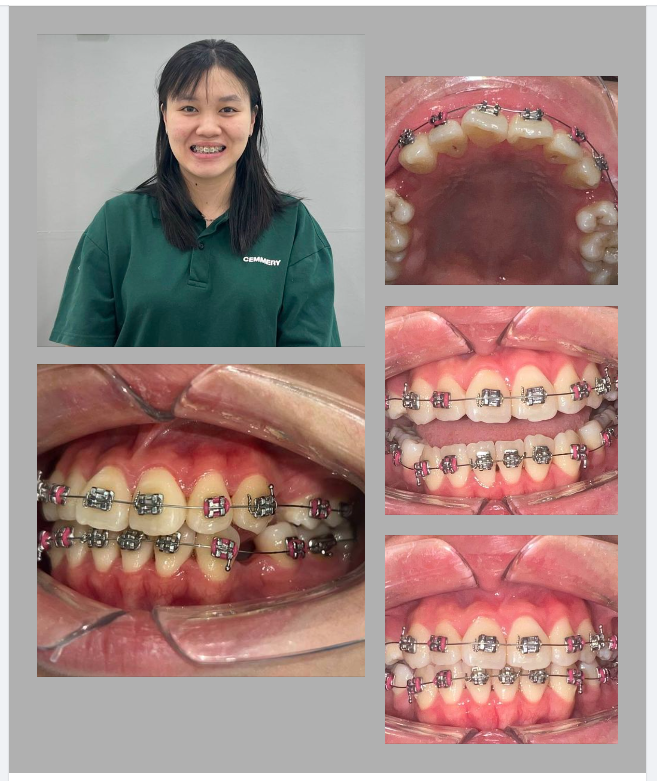 Hành trình đi tìm khớp cắn đúng của chị gái