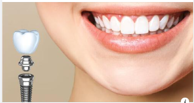 Cấy ghép Implant là gì? Có nên cấy Implant không?