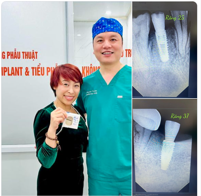  Hình ảnh 02 trụ implant bác sĩ cấy xuyên nướu và đặt trụ lành thương luôn