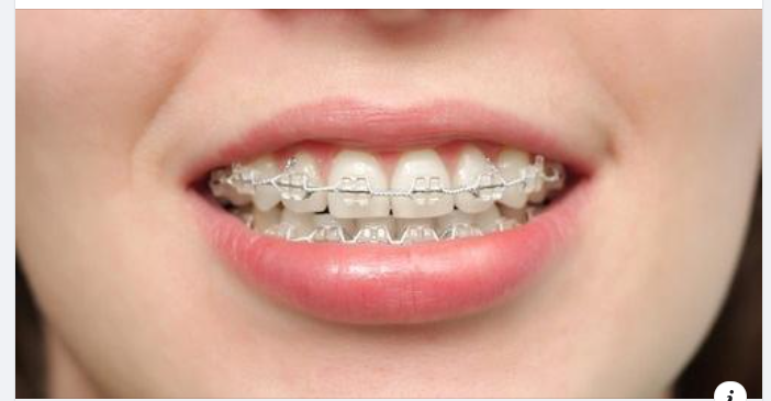 Niềng Răng Bằng Mắc Cài Sứ Có Tốt Không?