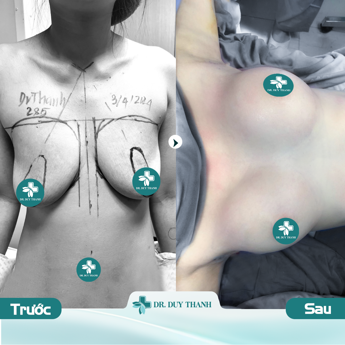 Dr Duy Thanh kiến tạo bầu ngực săn chắc