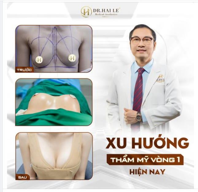 Điểm qua xu hướng nâng ngực hiện nay