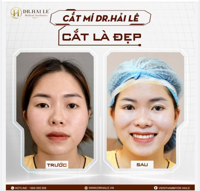 Cắt mí Dr.Hải Lê - Thẩm mỹ mắt nhanh chóng, an toàn, hiệu quả!