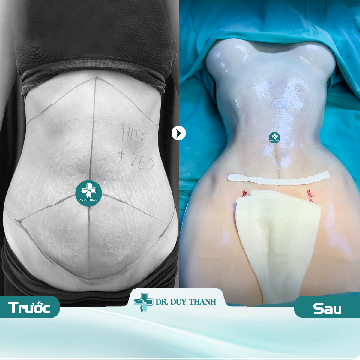 Dr Duy Thanh lấy lại vóc dáng chuẩn body Mỹ Latinh