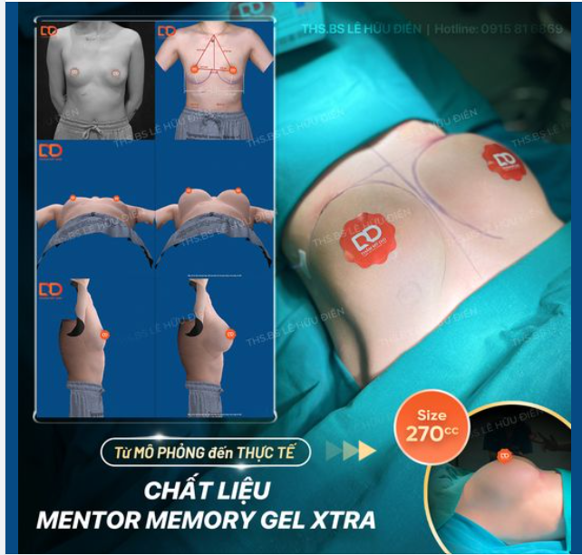 Tại sao cùng một size ngực nhưng kết quả thẩm mỹ khác nhau?