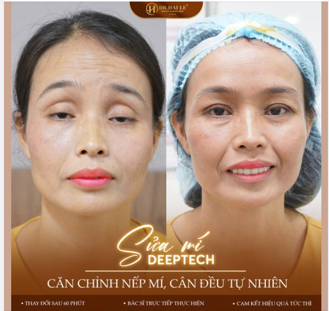 Kỹ thuật độc quyền sửa mí DEEPTECH, giúp chị em giải thoát khỏi "ám ảnh sợ hãi" về mí lỗi hỏng