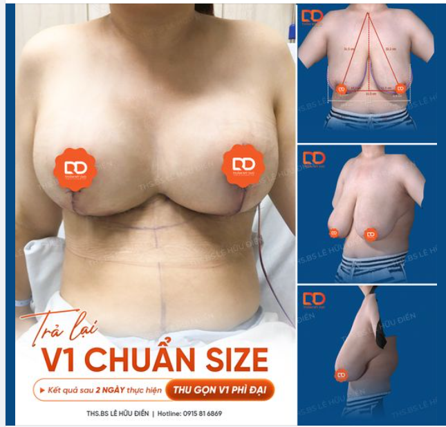 Khách hàng tâm sự: "Từ khi bắt đầu dậy thì, chưa bao giờ được nằm ngủ ngửa vì hai "quả tạ" đè nặng lên ngực. Thèm cảm giác ôm con vào lòng khi ngủ nhưng không được".