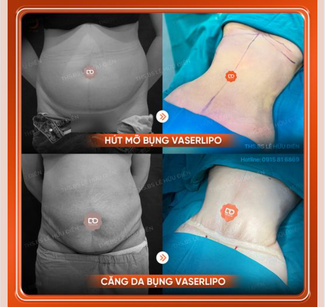 Muốn eo thon dáng gọn Nên chọn HÚT MỠ hay CĂNG DA BỤNG?