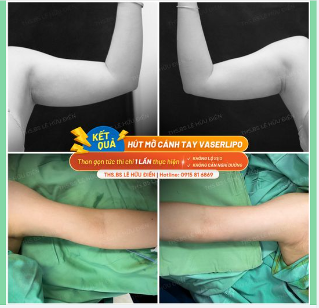 MỠ TAY KHÓ GIẢM THON GỌN TỨC THÌ CHỈ 1 LẦN THỰC HIỆN