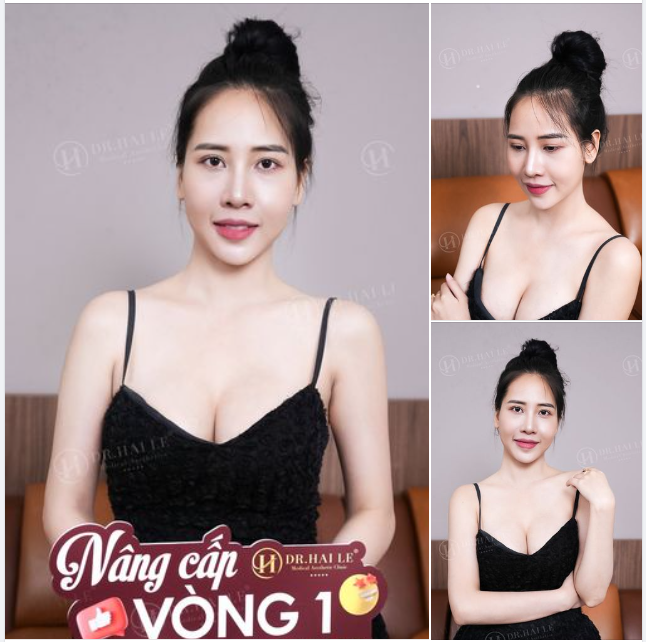 Ca nâng cấp vòng 1 tái khám sau 3 tháng tại Dr.Hải Lê.