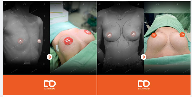 Kết quả 2 ca Nâng V1 đơn thuần của ngày hôm qua có rồi đây ạ.