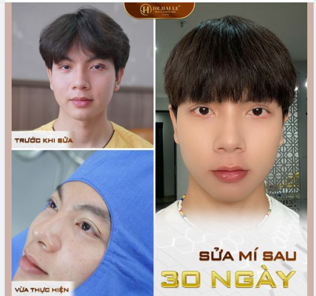 Ai nói chỉ con gái mới đi làm đẹp! Bạn Phụng đến với Dr.Hải Lê trong tình trạng: Mí sửa hỏng, sưng bầm Mắt đa nếp mí