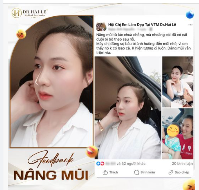 Nâng mũi xong bầu bì liệu có ảnh hưởng gì  không?