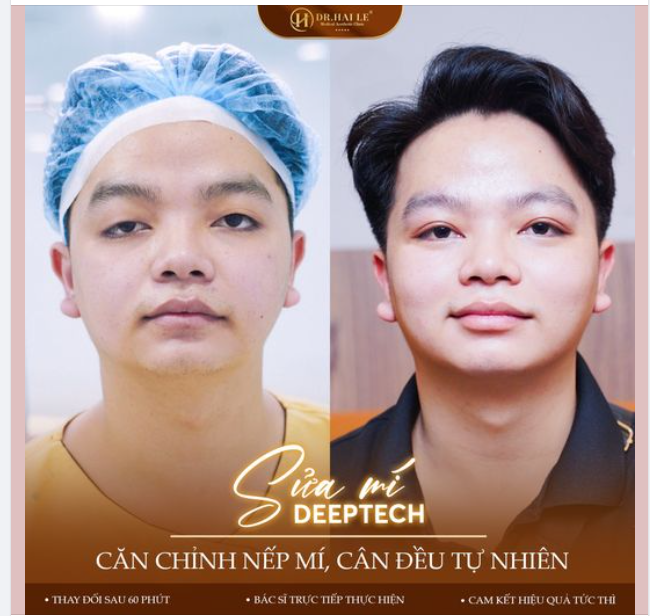 Thay đổi ngoạn mục của đôi mắt ."Từ giờ không còn bị hỏi sao mày "mắt nổ - mắt xịt" nữa rồi. Cảm ơn bác sĩ tại Dr.Hải Lê rất nhiều" bạn Khách chia sẻ