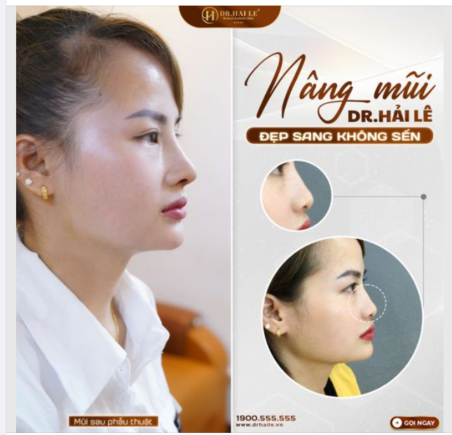 Chỉ 45 phút thực hiện - 10 ngày cắt chỉ là bạn có thể sở hữu ngay dáng mũi cao bay, đẹp sang không sến và đặc biệt phù hợp với các đường nét trên gương mặt.