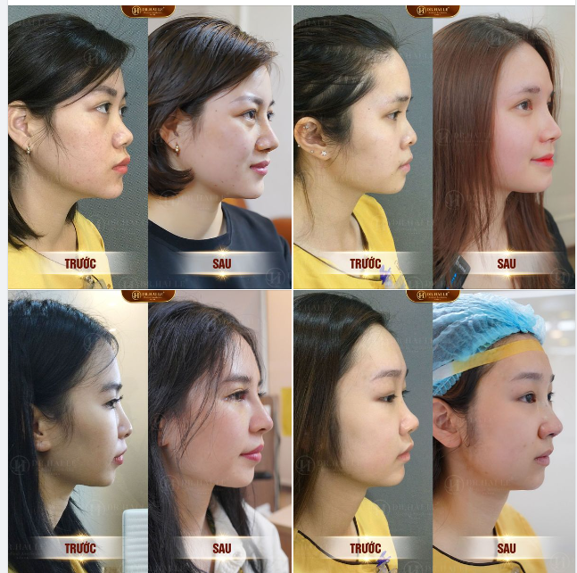TỔNG HỢP KHÁCH HÀNG NÂNG MŨI THÀNH CÔNG TẠI DR.HẢI LÊ ️