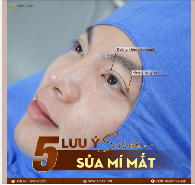 5 LƯU Ý SAU KHI SỬA MÍ MẮT