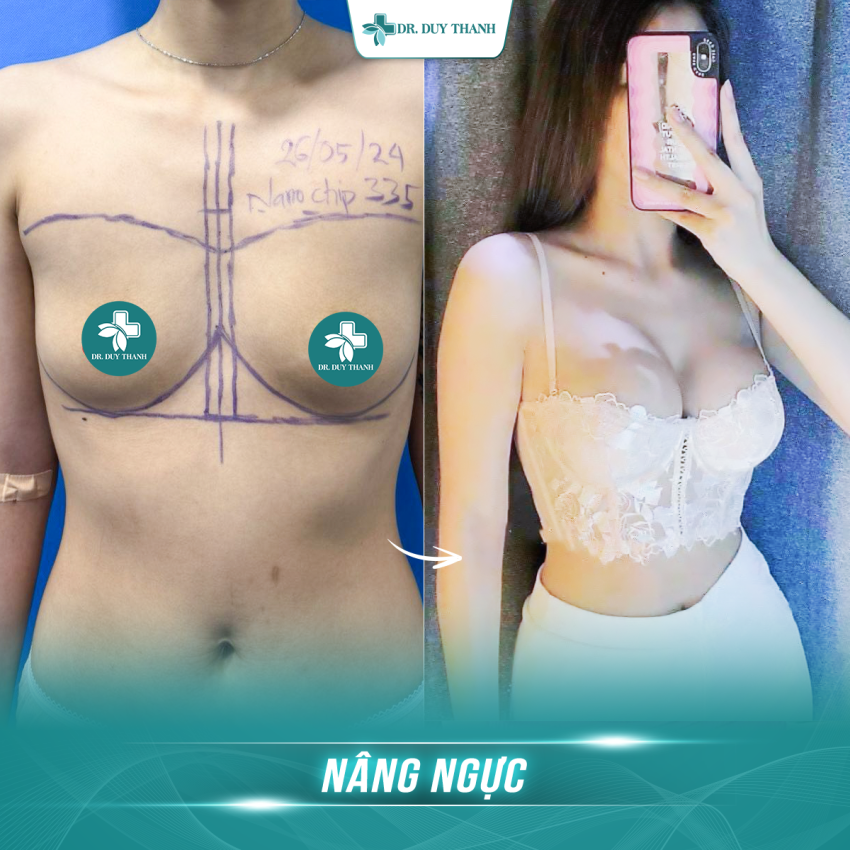 Nâng Ngực - Những điều ít ai biết khi muốn phẫu thuật thẩm mỹ
