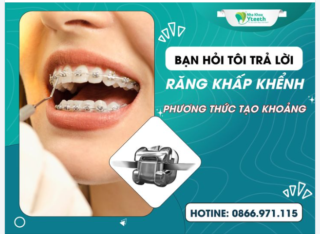 BẠN HỎI TÔI TRẢ LỜI - RĂNG KHẤP KHỂNH: PHƯƠNG THỨC TẠO KHOẢNG ĐỂ NIỀNG RĂNG KHẤP KHỂNH