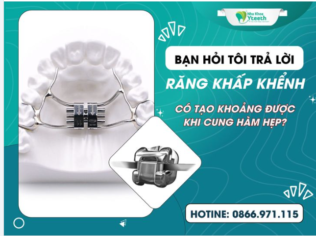 BẠN HỎI TÔI TRẢ LỜI - RĂNG KHẤP KHỂNH: TRONG TRƯỜNG HỢP CUNG HÀM BỊ HẸP THEO CHIỀU NGANG, MỨC ĐỘ KHẤP KHỂNH KHÔNG NHIỀU, CÓ THỂ TẠO KHOẢNG ĐƯỢC KHÔNG? 