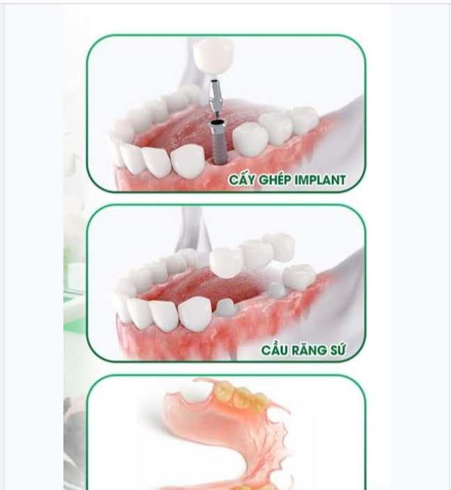CÁC PHƯƠNG PHÁP KHÔI PHỤC RĂNG MẤT HIỆN NAY