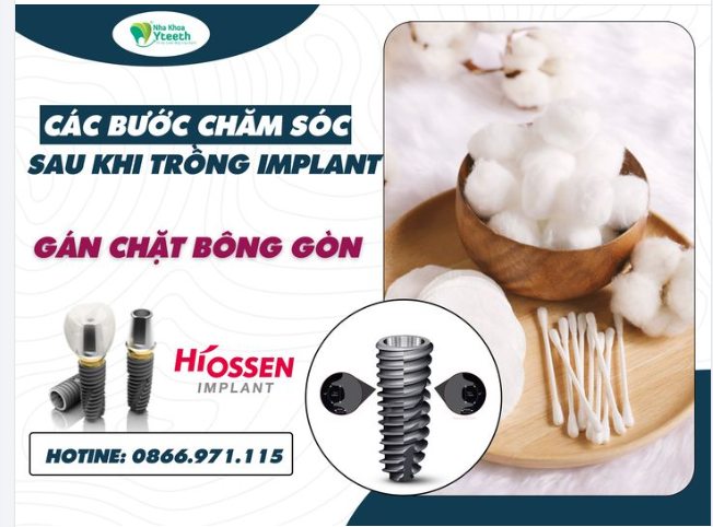 Tình trạng chảy máu sau khi cắm trụ Implant là điều bình thường. Bác sĩ sẽ hướng dẫn bệnh nhân cắn chặt bông gòn trong khoảng 30 phút, cho đến khi máu đông lại.