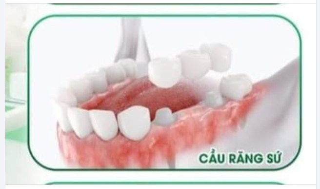 Mất răng gây xô lệch hàm dẫn tới khớp cắn lệch lạc. Từ đó gây cản trở hoạt động ăn nhai, lâu dần sẽ bị đau nhức khớp thái xương hàm, mỏi hàm.