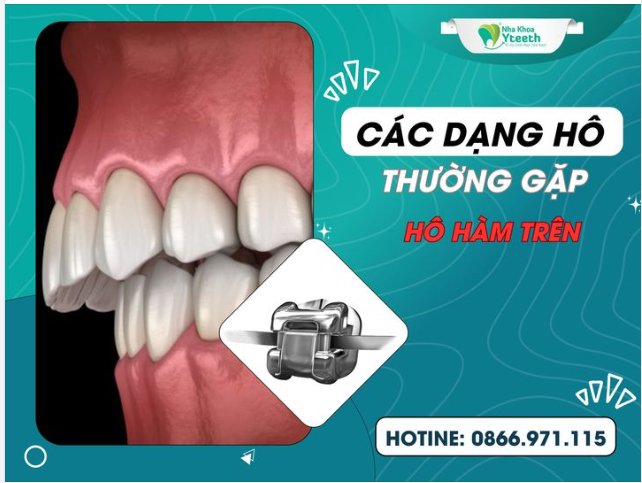Các rạng hô thường gặp - hô hàm trên