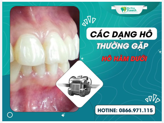 Câc rạng hô thường gặp - Hô hàm dưới