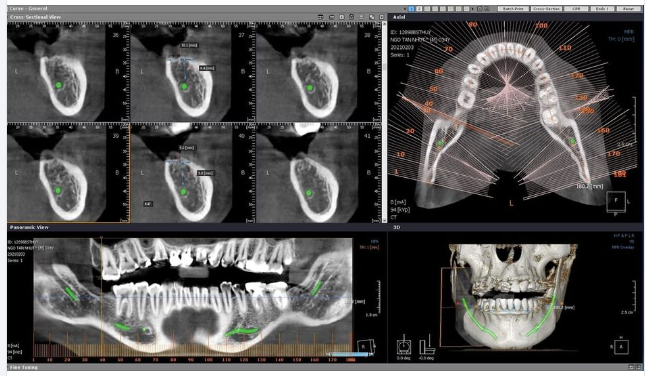 7 CÁCH CHĂM SÓC RĂNG IMPLANT SAU KHI CẤY GHÉP