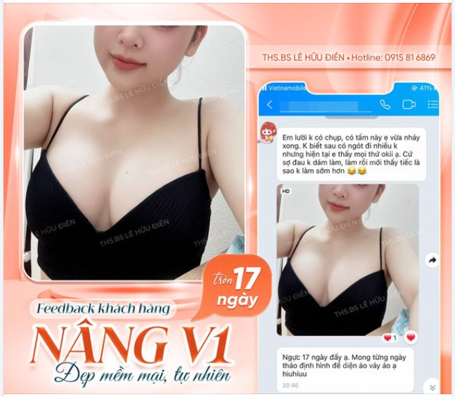 KHÁCH HÀNG FEEDBACK SAU 17 NGÀY NÂNG V1 TẠI BÁC SĨ ĐIỀN