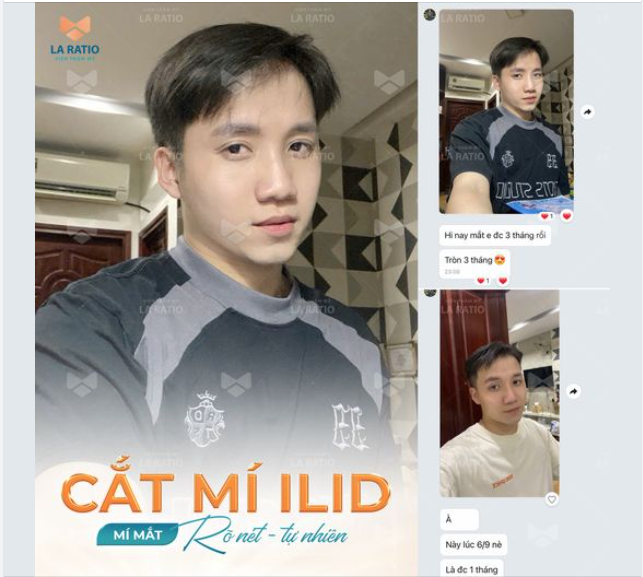 Câu chuyện người thật - việc thật từ khách hàng sau khi đã sử dụng dịch vụ cắt mí ILID tại viên thẩm mỹ La Ratio
