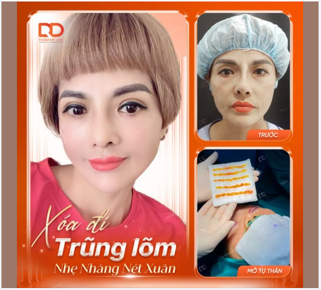 Xoá đi trũng lõm - Nhẹ nhàng nét xuân