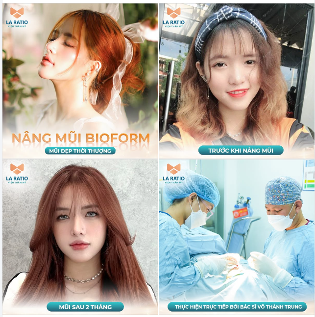 MŨI CAO TỰ NHIÊN - ĐẸP KHÔNG TÌ VẾT ĐÓN TẾT SANG