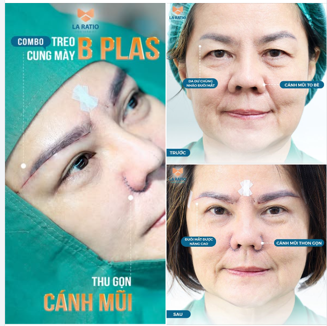 Combo treo cung mày + thu nhỏ cánh mũi nâng cấp nhan sắc - trẻ hóa toàn diện