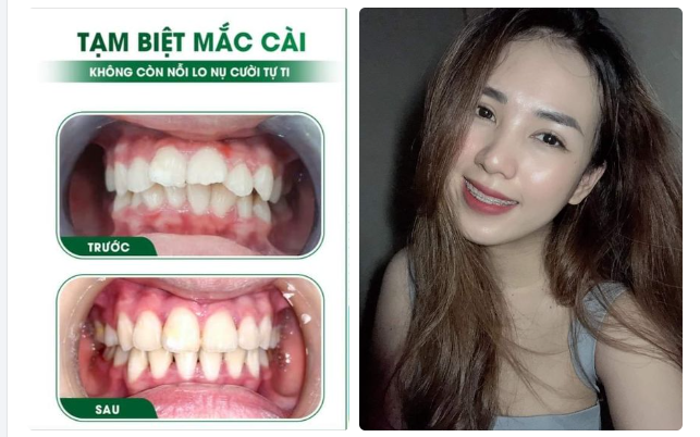 TẠM BIỆT MẮC CÀI - KHÔNG CÒN NỖI LO NỤ CƯỜI TỰ TI