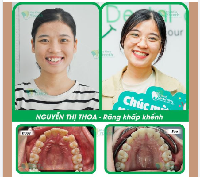 Các bạn thấy niềng răng thay đổi cỡ nào?